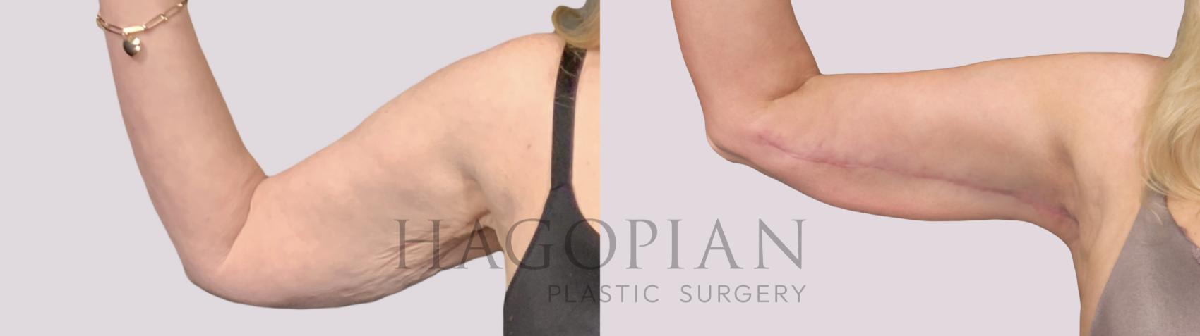 Before & After Arm Lift Case 33 Front Left View in Atlanta, GA