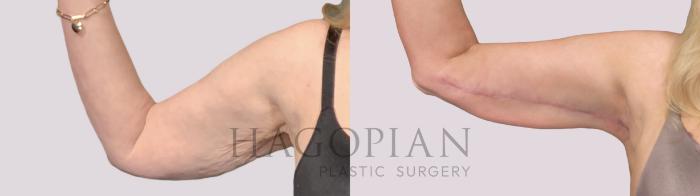 Before & After Arm Lift Case 33 Front Left View in Atlanta, GA