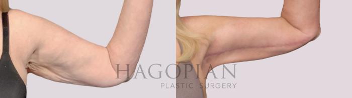 Before & After Arm Lift Case 33 Front Right View in Atlanta, GA
