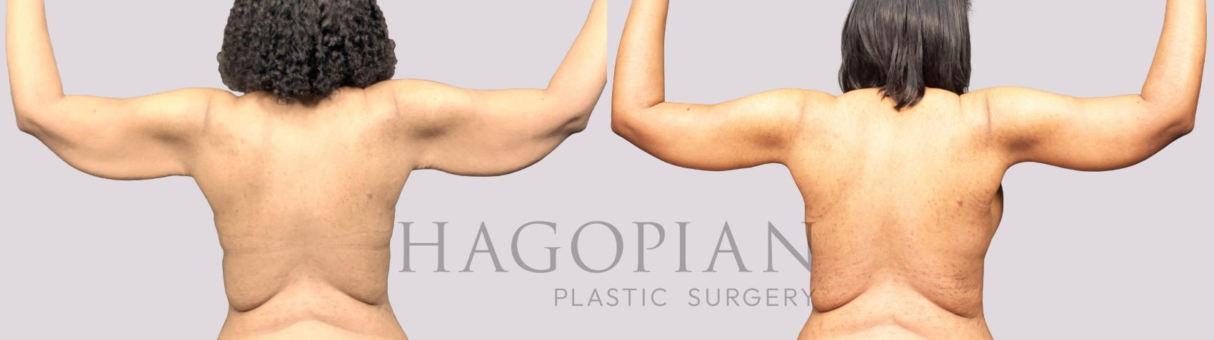 Before & After Arm Lift Case 36 Back View in Atlanta, GA