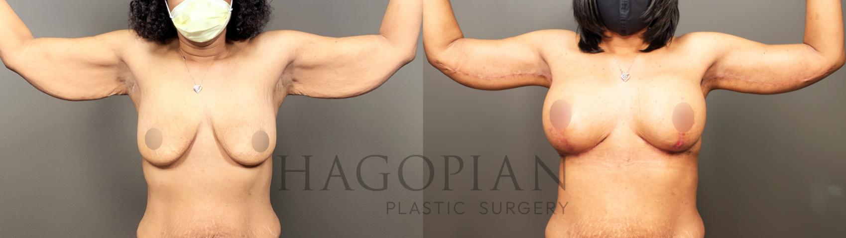 Before & After Arm Lift Case 36 Front View in Atlanta, GA