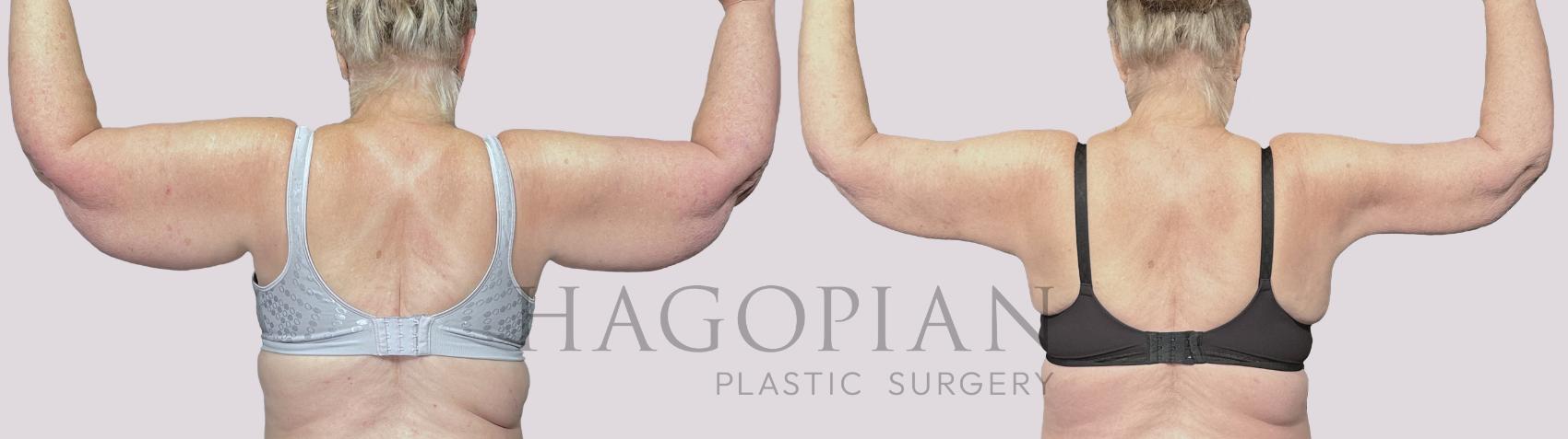 Before & After Arm Lift Case 55 Back View in Atlanta, GA