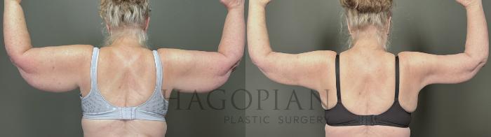 Before & After Arm Lift Case 55 Back View in Atlanta, GA