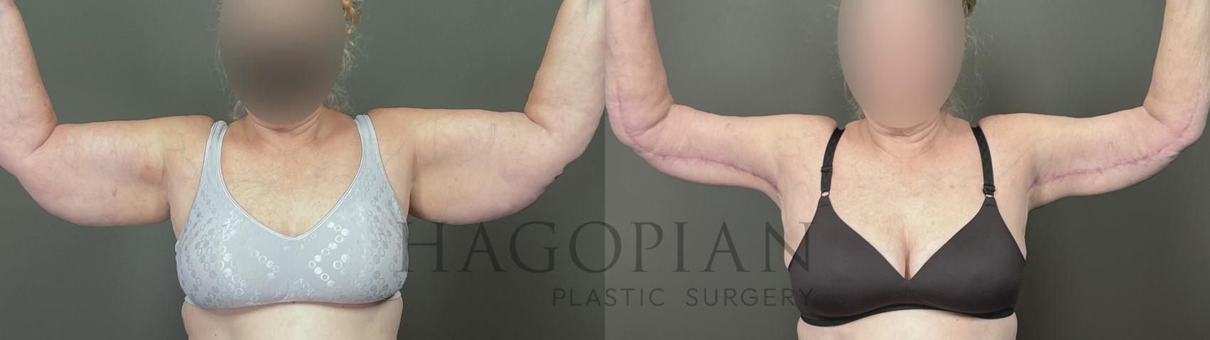 Before & After Arm Lift Case 55 Front View in Atlanta, GA