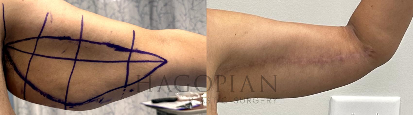 Before & After Arm Lift Case 67 Left Side View in Atlanta, GA