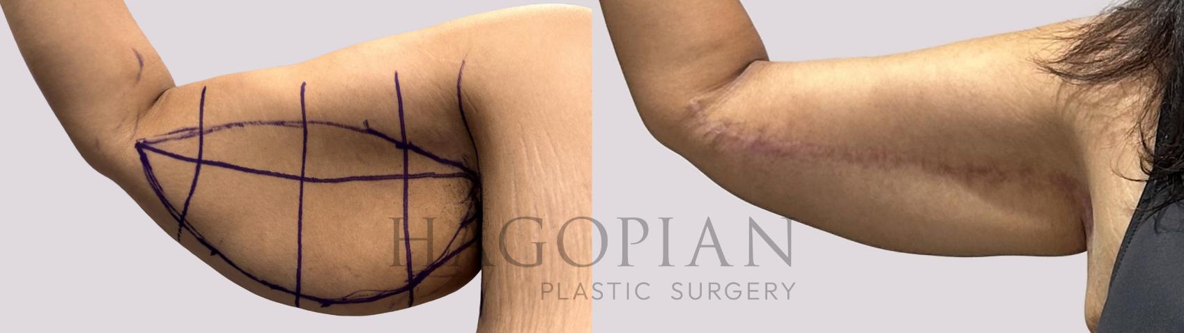 Before & After Arm Lift Case 67 Right Side View in Atlanta, GA