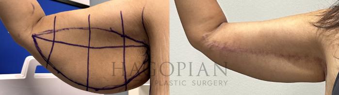 Before & After Arm Lift Case 67 Right Side View in Atlanta, GA