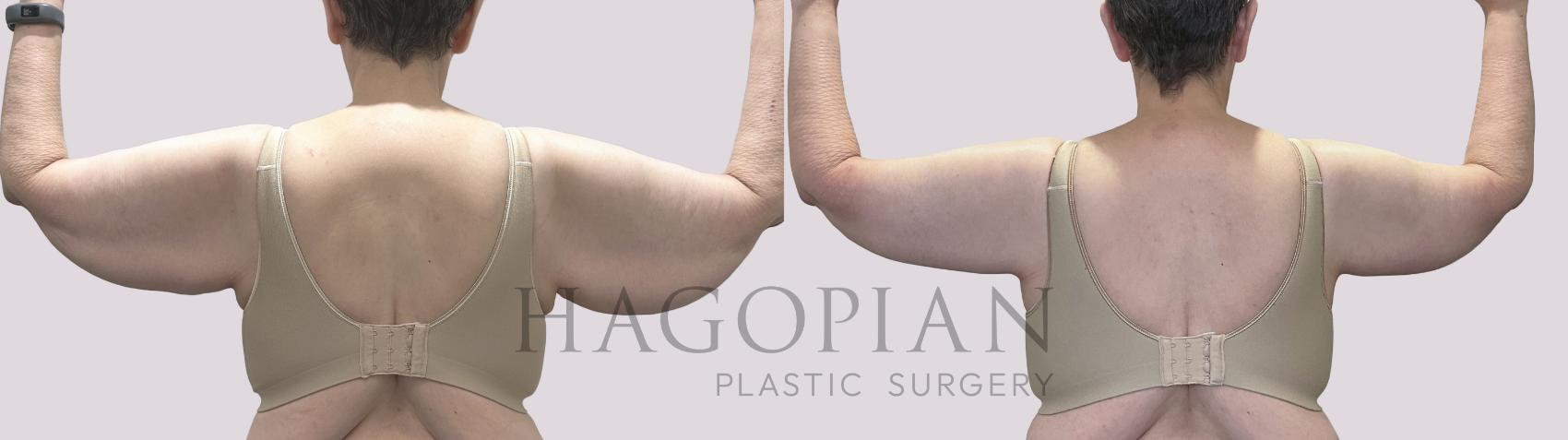 Before & After Arm Lift Case 71 Back View in Atlanta, GA