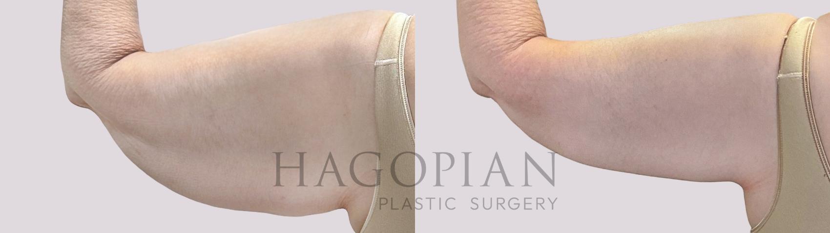 Before & After Arm Lift Case 71 Back Left View in Atlanta, GA