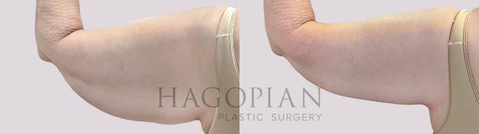 Before & After Arm Lift Case 71 Back Left View in Atlanta, GA