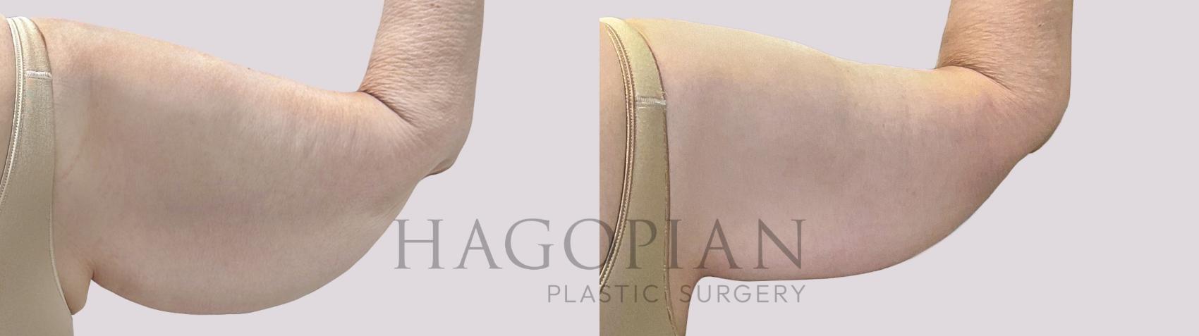 Before & After Arm Lift Case 71 Back Right View in Atlanta, GA