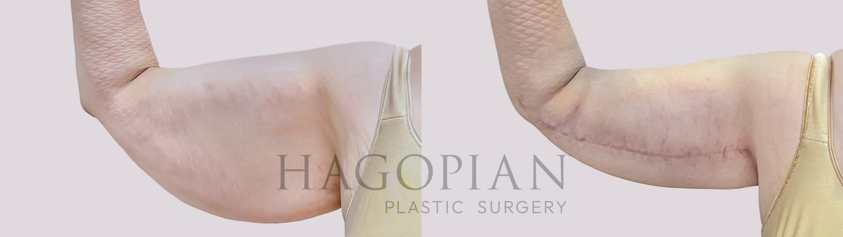 Before & After Arm Lift Case 71 Front Left View in Atlanta, GA