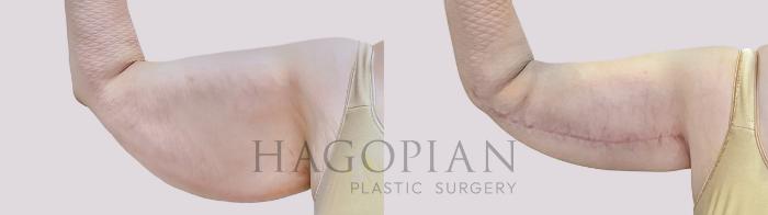 Before & After Arm Lift Case 71 Front Left View in Atlanta, GA