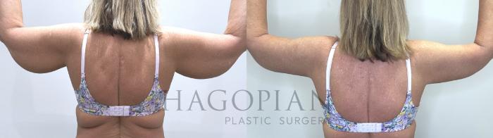 Before & After Arm Lift Case 72 Back View in Atlanta, GA