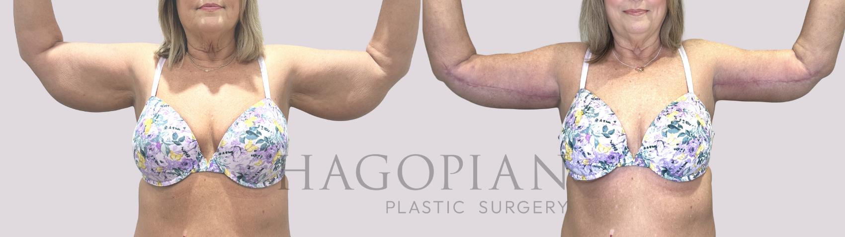 Before & After Arm Lift Case 72 Front View in Atlanta, GA