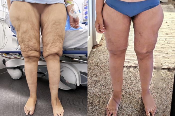 Before & After Lipedema Surgery Case 105 Front View in Atlanta, GA