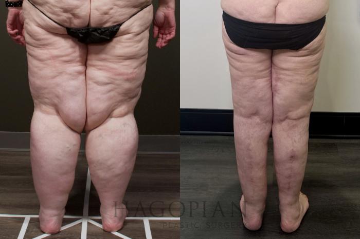Before & After Arm & Thigh Lift Case 110 Back View in Atlanta, GA