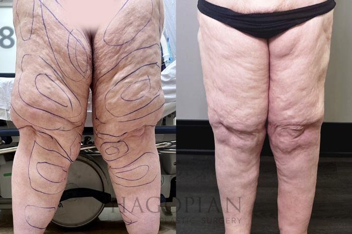 Before & After Lipedema Surgery Case 110 Front View in Atlanta, GA