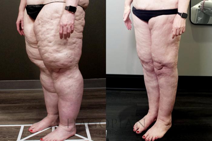 Before & After Arm & Thigh Lift Case 110 Left Oblique View in Atlanta, GA