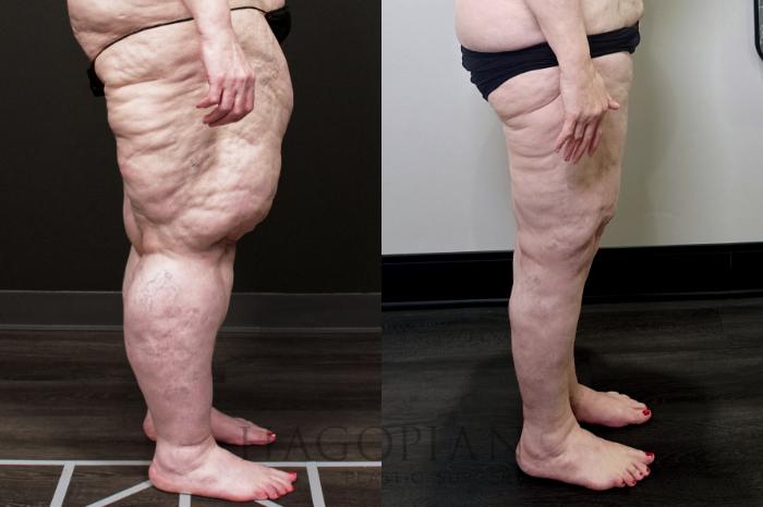 Before & After Arm & Thigh Lift Case 110 Right Side View in Atlanta, GA