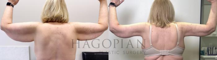 Before & After Arm & Thigh Lift Case 111 Back View in Atlanta, GA