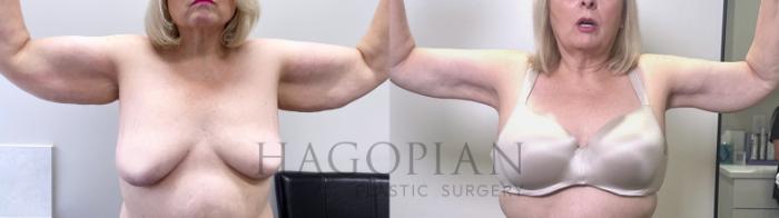 Before & After Arm & Thigh Lift Case 111 Front View in Atlanta, GA