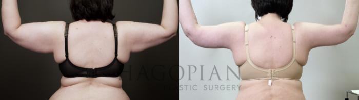 Before & After Arm & Thigh Lift Case 120 Back View in Atlanta, GA