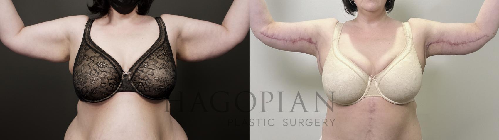 Before & After Arm & Thigh Lift Case 120 Front View in Atlanta, GA