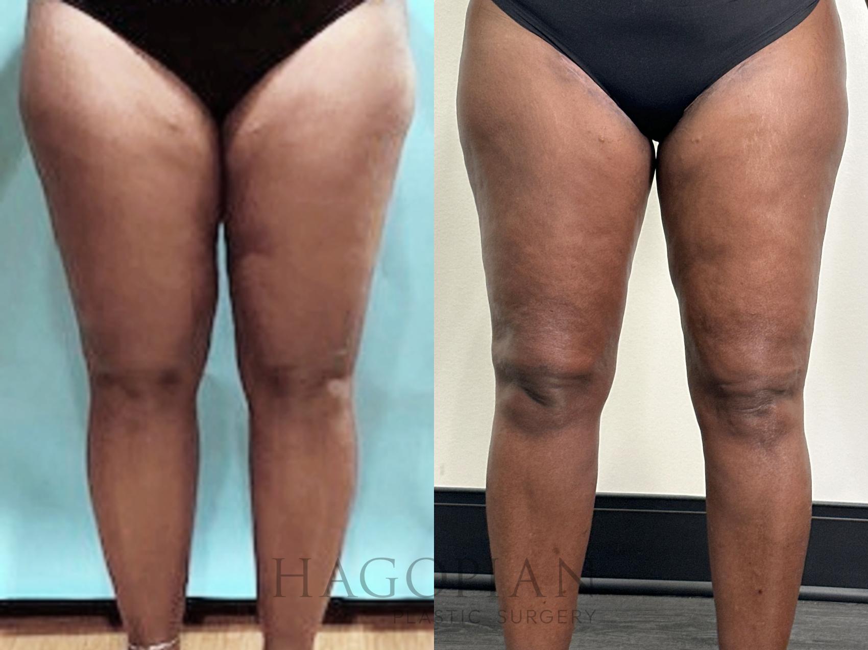 Before & After Arm & Thigh Lift Case 128 Front View in Atlanta, GA