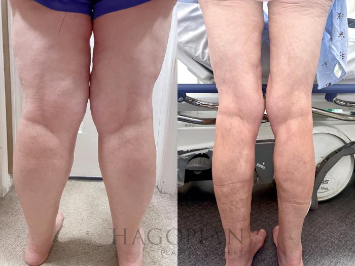 Before & After Arm & Thigh Lift Case 130 Back View in Atlanta, GA