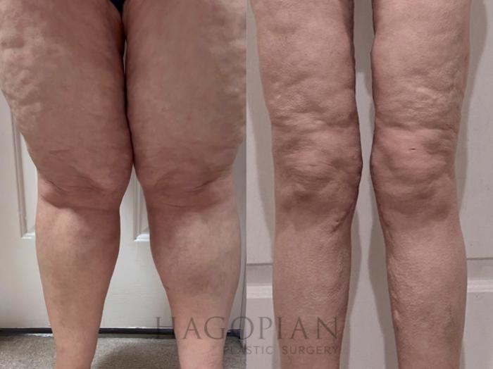 Before & After Lipedema Surgery Case 130 Front View in Atlanta, GA