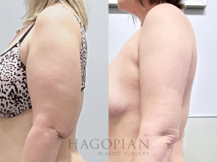 Before & After Arm & Thigh Lift Case 132 Back View in Atlanta, GA