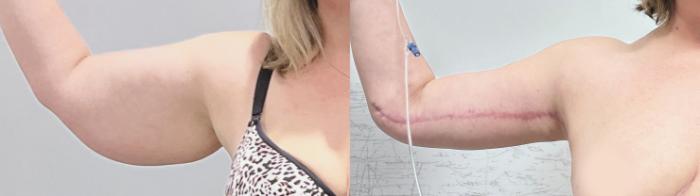 Before & After Arm & Thigh Lift Case 132 Front View in Atlanta, GA