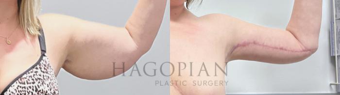 Before & After Arm & Thigh Lift Case 132 Left Side View in Atlanta, GA