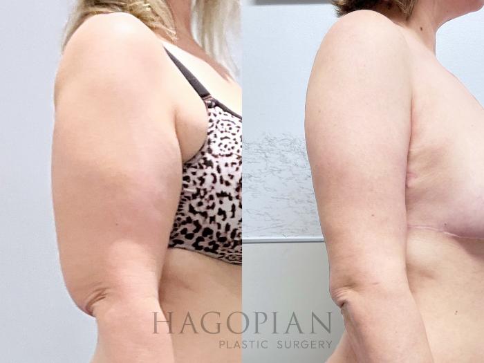 Before & After Lipedema Surgery Case 132 Right Side View in Atlanta, GA