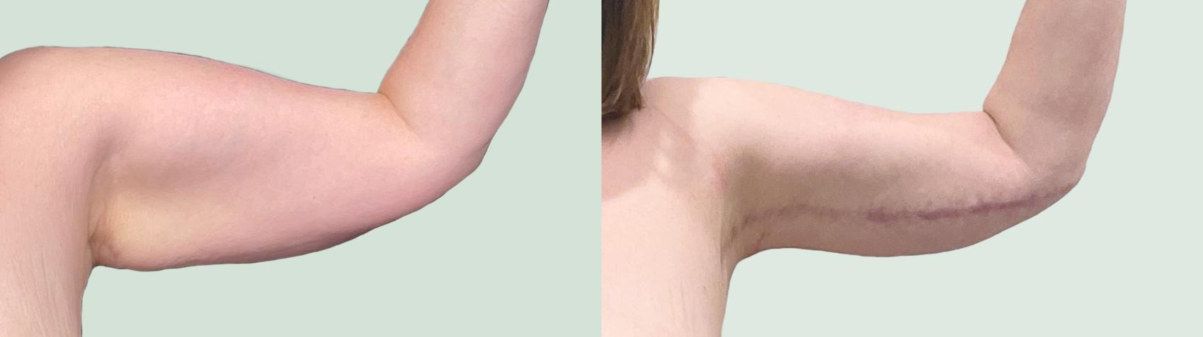 Before & After Arm Lift Case 142 Left Side View in Atlanta, GA
