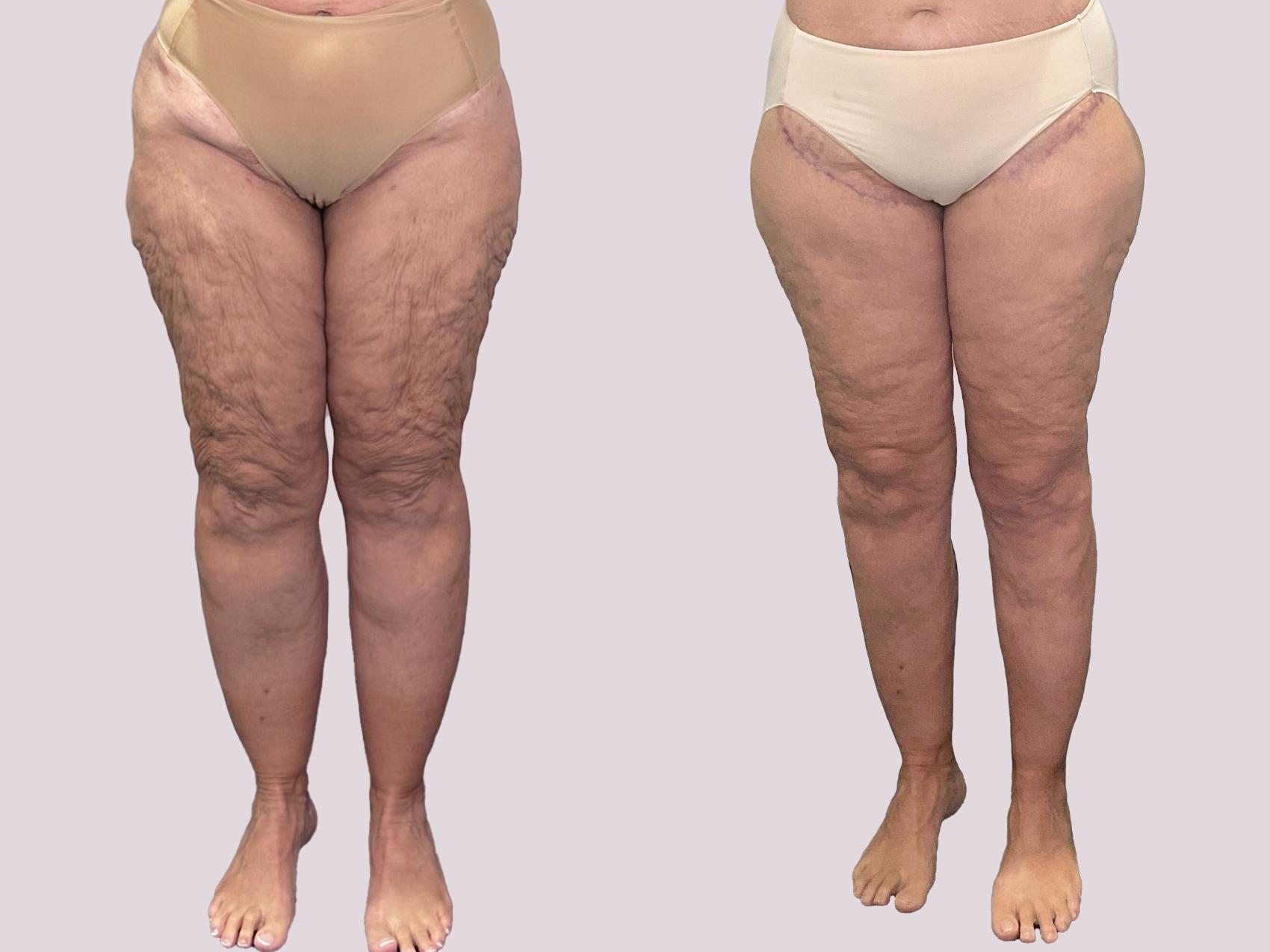 Before & After Lipedema Surgery Case 163 Front View in Atlanta, GA