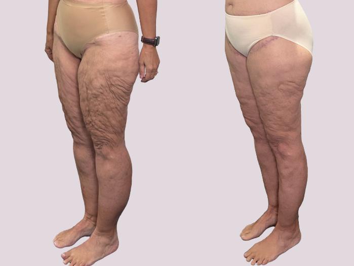 Before & After Lipedema Surgery Case 163 Left Oblique View in Atlanta, GA