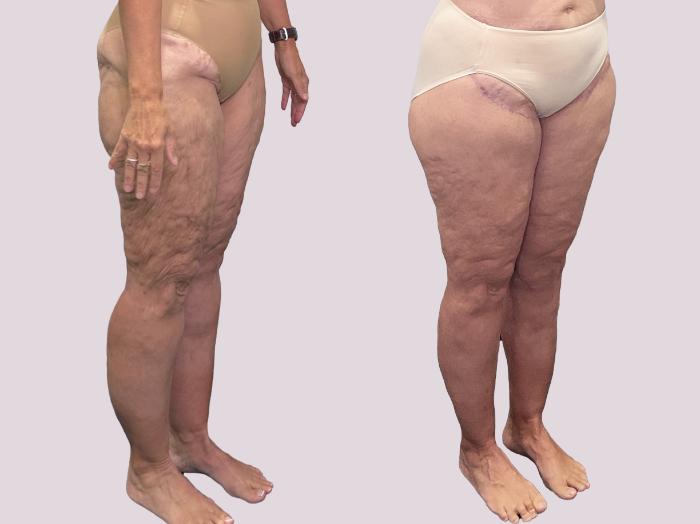 Before & After Lipedema Surgery Case 163 Right Oblique View in Atlanta, GA