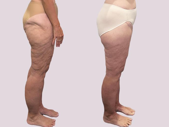 Before & After Lipedema Surgery Case 163 Right Side View in Atlanta, GA