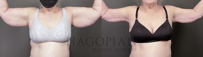 Before & After Arm & Thigh Lift Case 21 Front View in Atlanta, GA