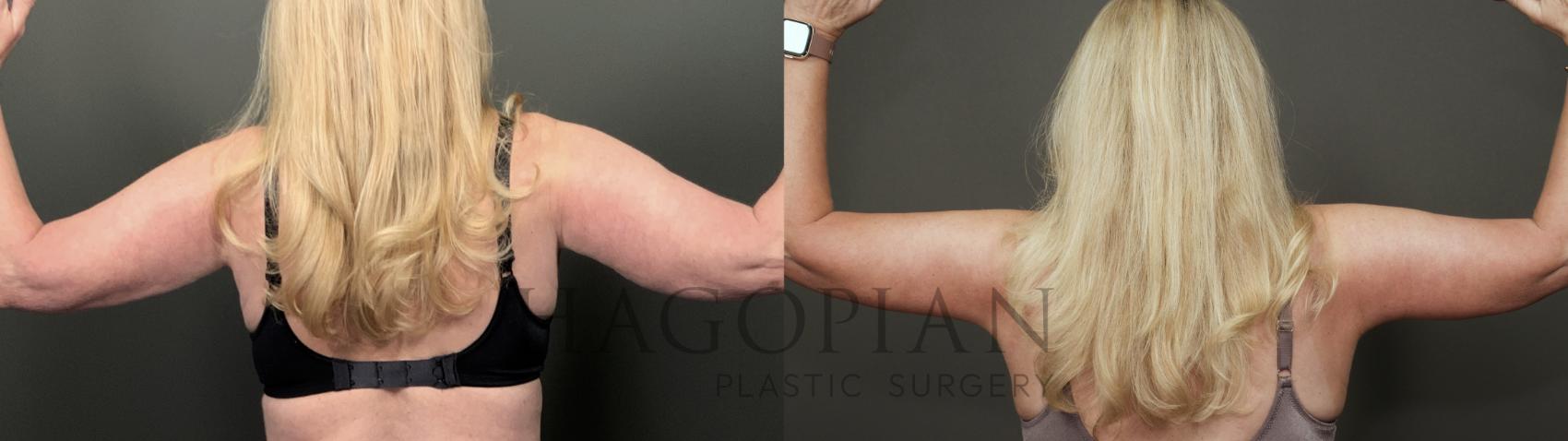 Before & After Arm & Thigh Lift Case 33 Back View in Atlanta, GA