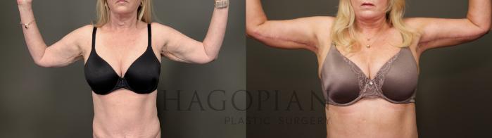 Before & After Arm & Thigh Lift Case 33 Front View in Atlanta, GA