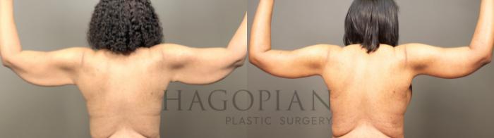 Before & After Arm & Thigh Lift Case 36 Back View in Atlanta, GA