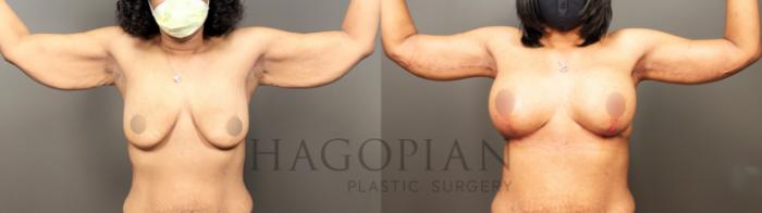 Before & After Arm & Thigh Lift Case 36 Front View in Atlanta, GA
