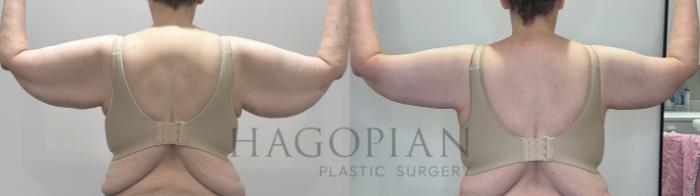 Before & After Arm & Thigh Lift Case 71 Back View in Atlanta, GA