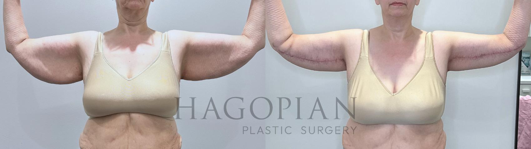 Before & After Arm & Thigh Lift Case 71 Front View in Atlanta, GA