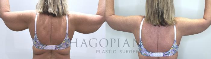 Before & After Arm & Thigh Lift Case 72 Back View in Atlanta, GA