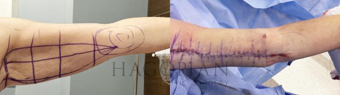 Before & After Arm & Thigh Lift Case 73 front straight View in Atlanta, GA