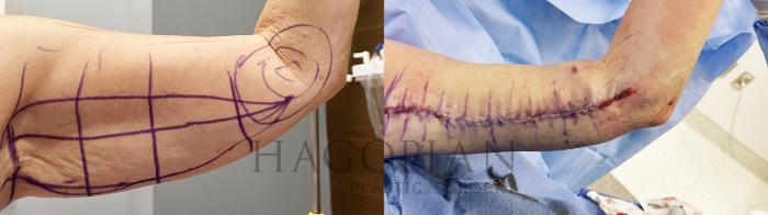 Before & After Arm & Thigh Lift Case 73 Front View in Atlanta, GA